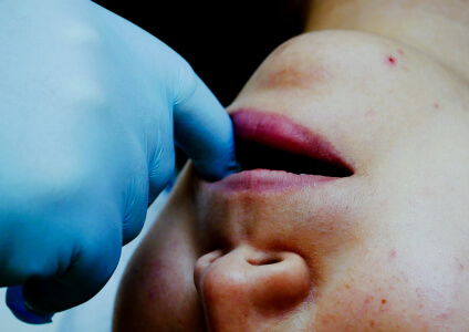 intraoral-massage