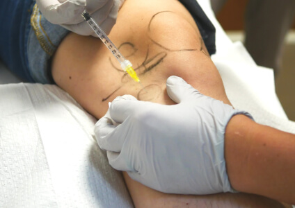 prolotherapy