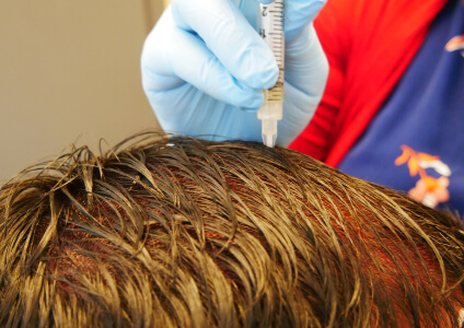 prp-hair-restoration